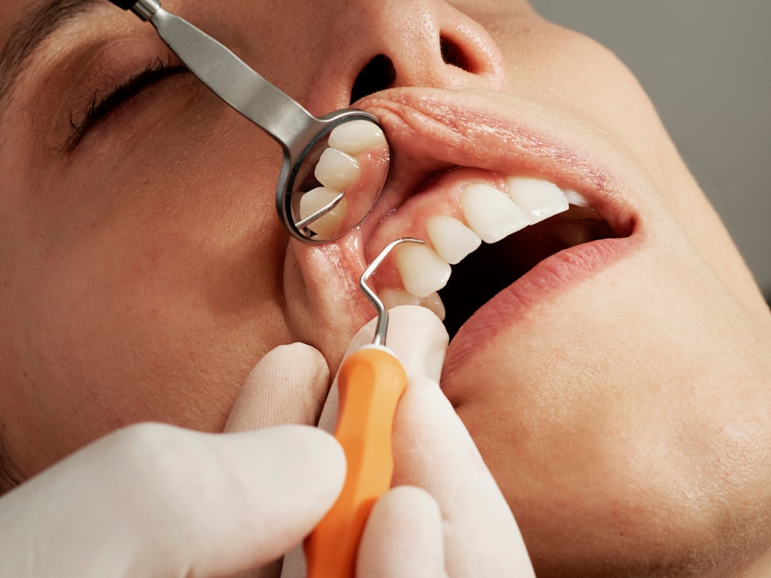 Painless Root Canal Treatment (RCT)